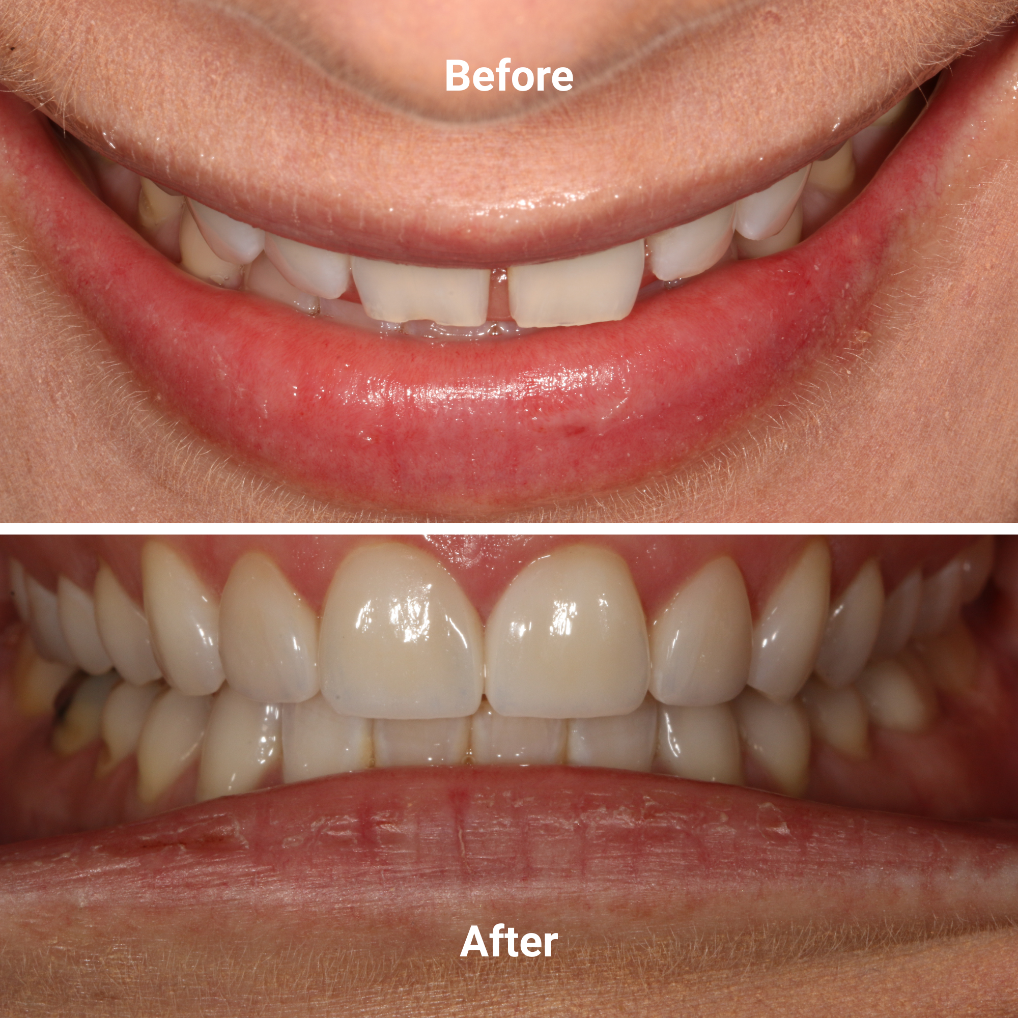 Veneers before and after